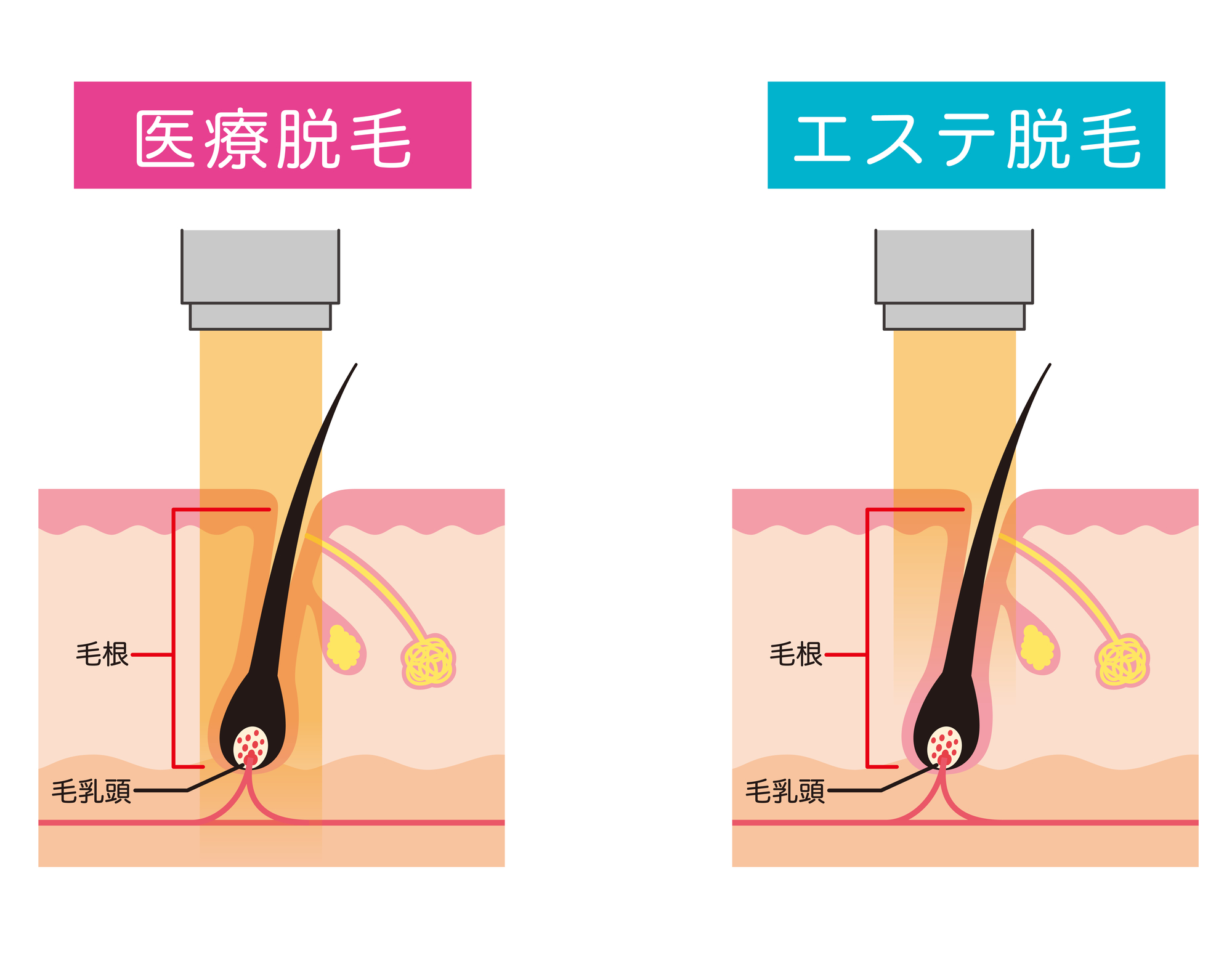 医療脱毛と美容脱毛