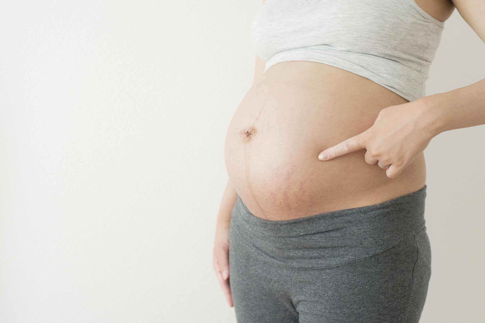妊娠線とは?